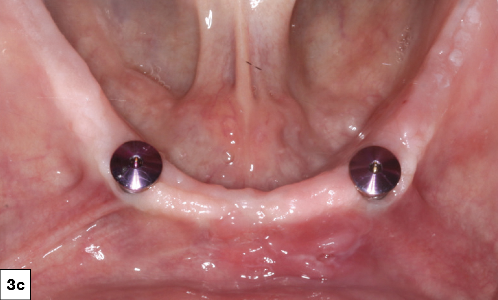Figure 3c: 3-mm-tall healing abutments were placed in the maxilla