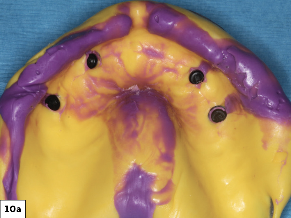 Figure 10a: Custom trays used for impressions