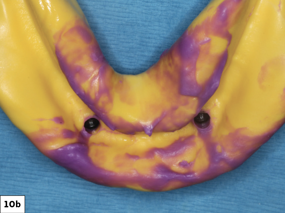 Figure 10b: Custom trays used for impressions