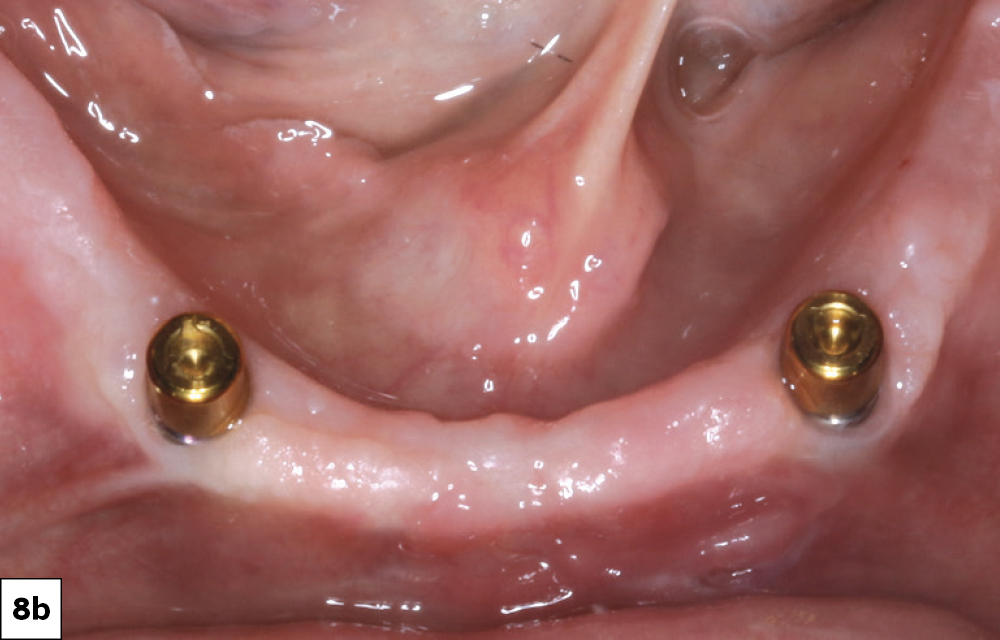 Figure 8b: locator abutments screwed in