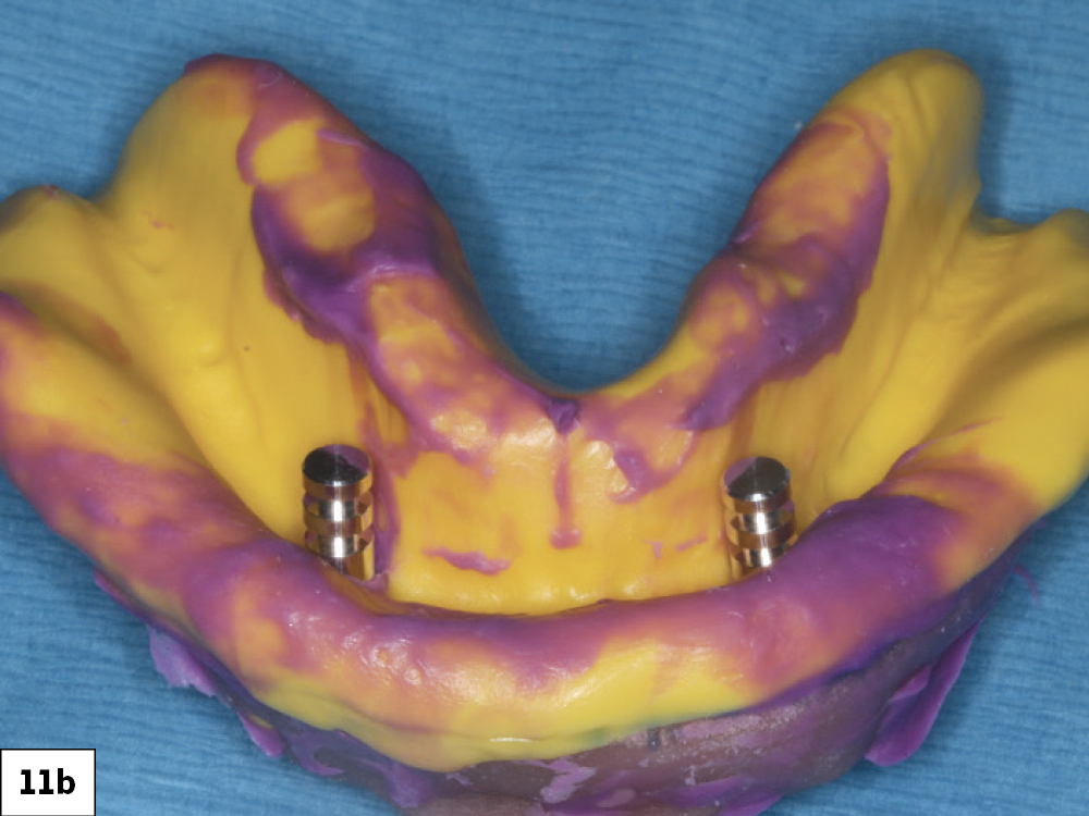 Figure 11b: locator analogs placed into locator impression copings