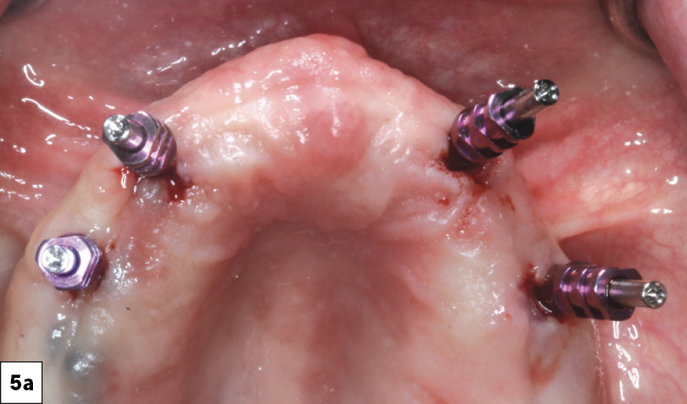 Figure 5a: open-tray implant impressions