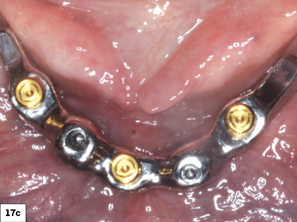 Figure 17c: milled bars can be attached to dental implants