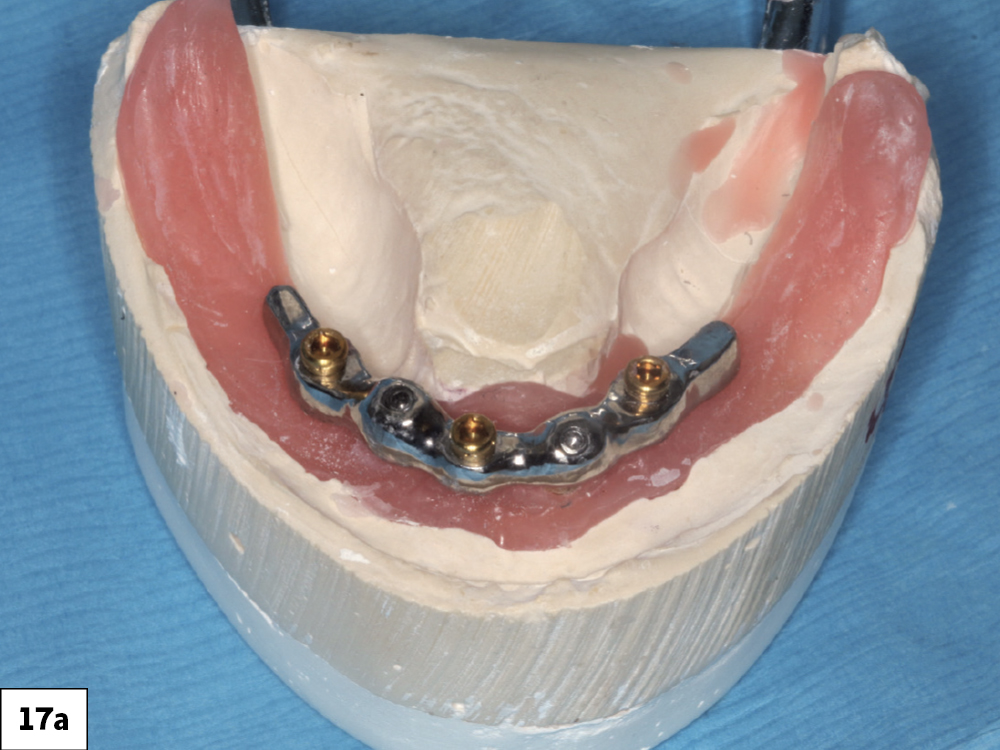 Figure 17a: milled bars can be attached to dental implants