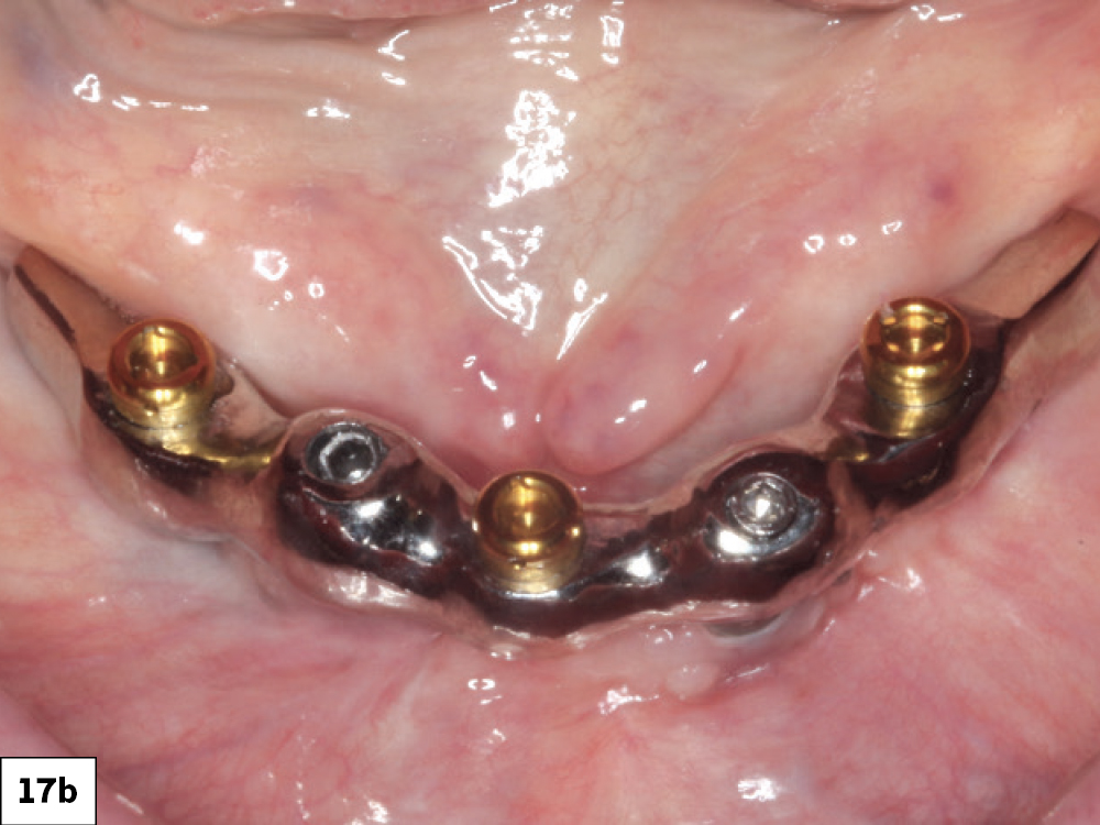 Figure 17b: milled bars can be attached to dental implants