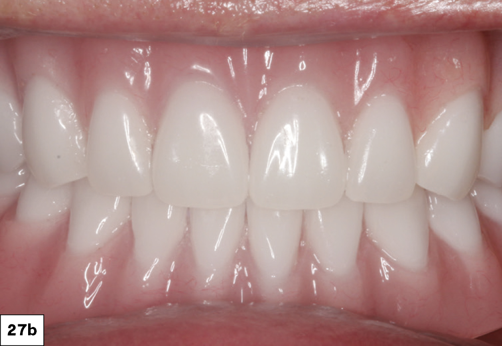 Figure 27b: patient's teeth after procedure