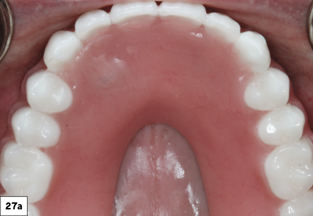 Figure 27a: patient's teeth post bar-splinted mandibular