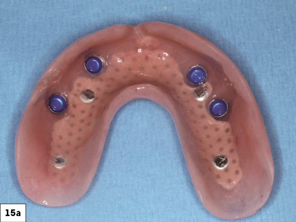 Figure 15a: overdentures