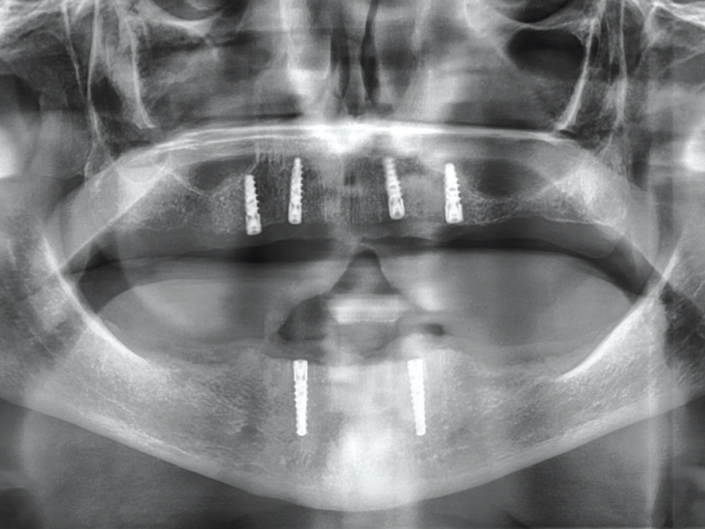 Figure 2: panoramic x-ray showing four maxillary Hahn™ Tapered Implants