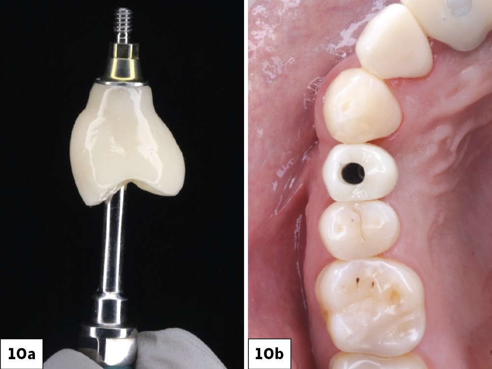 A screwmentable BruxZir crown was selected as the final restoration