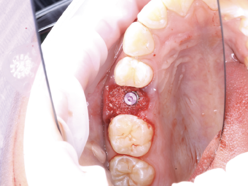 Newport Surgical Cortico/Cancellous Allograft Blend was used to graft the implant site.