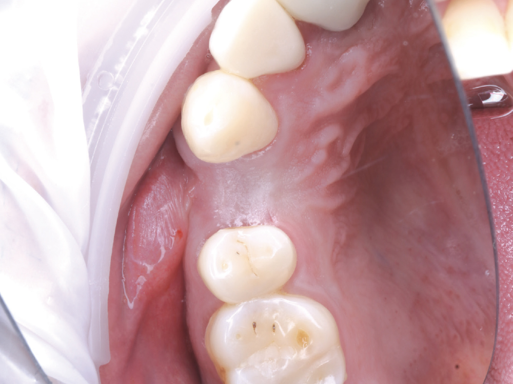 After five months of healing, the buccal showed an insufficient amount of attached tissue