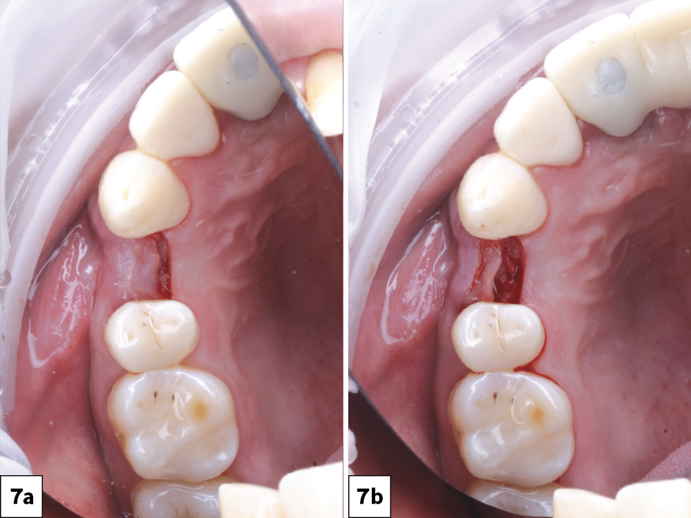 The mucogingival junction and keratinized tissue were exposed