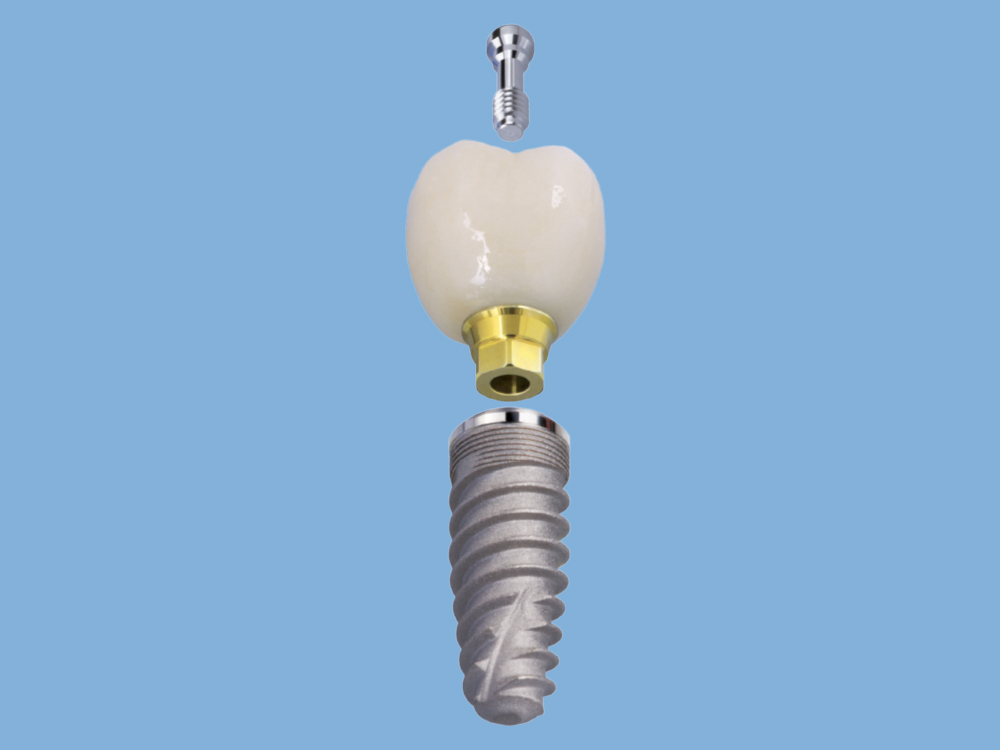 This BruxZir restoration is fabricated directly to a titanium base that is designed specifically for the implant platform.