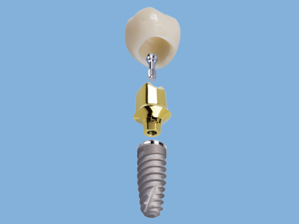 Cement-retained crown has a CAD/CAM custom abutment with BruxZir crown