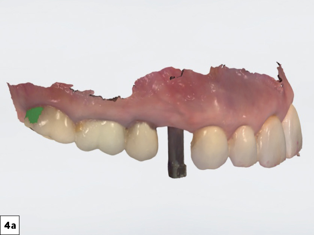 A digital impression was taken with a scan body in place, and the screw-retained restoration was designed