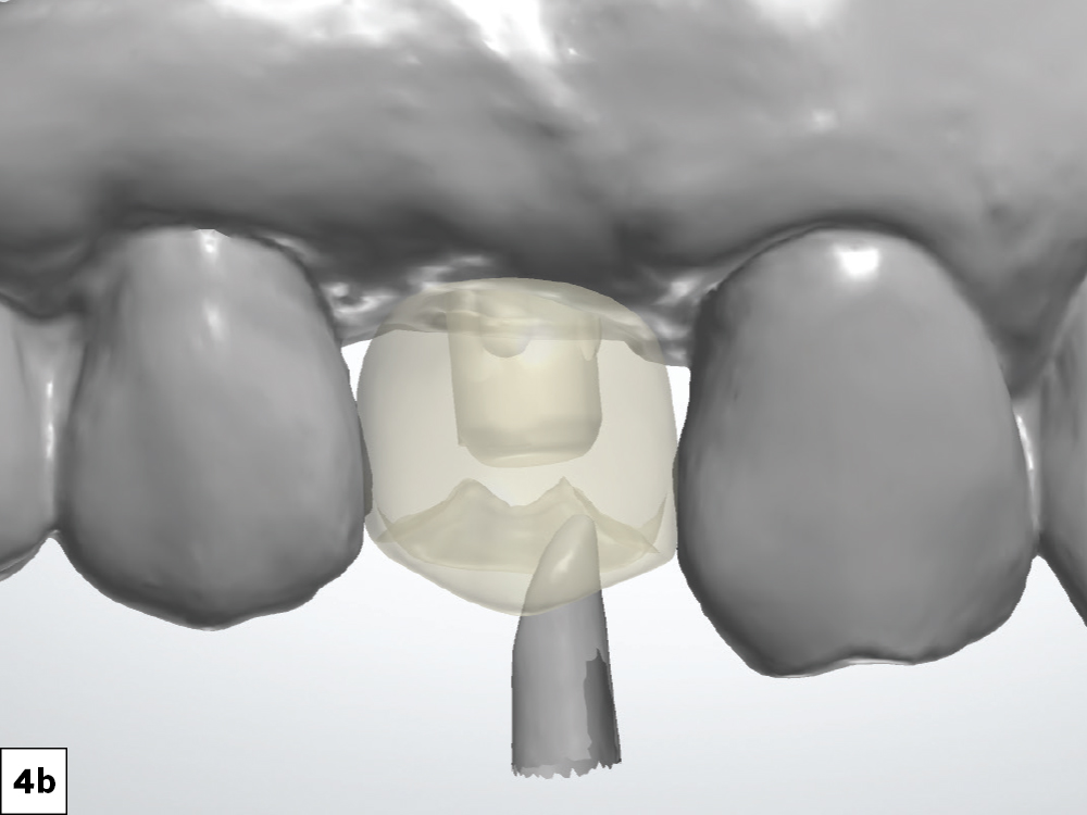A digital impression was taken with a scan body in place, and the screw-retained restoration was designed