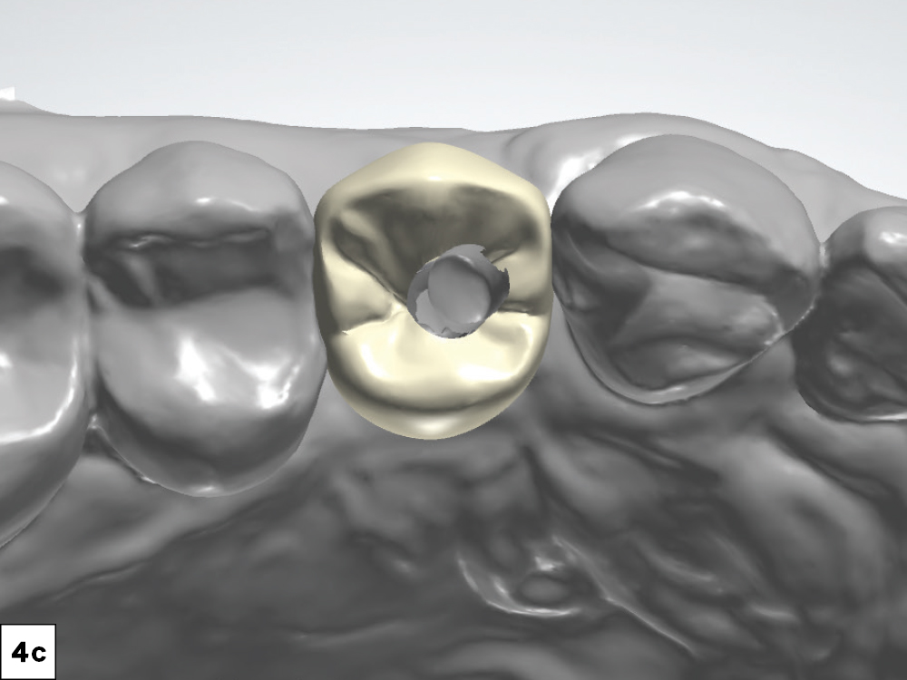 Note the optimal emergence profile and placement of the screw access channel.