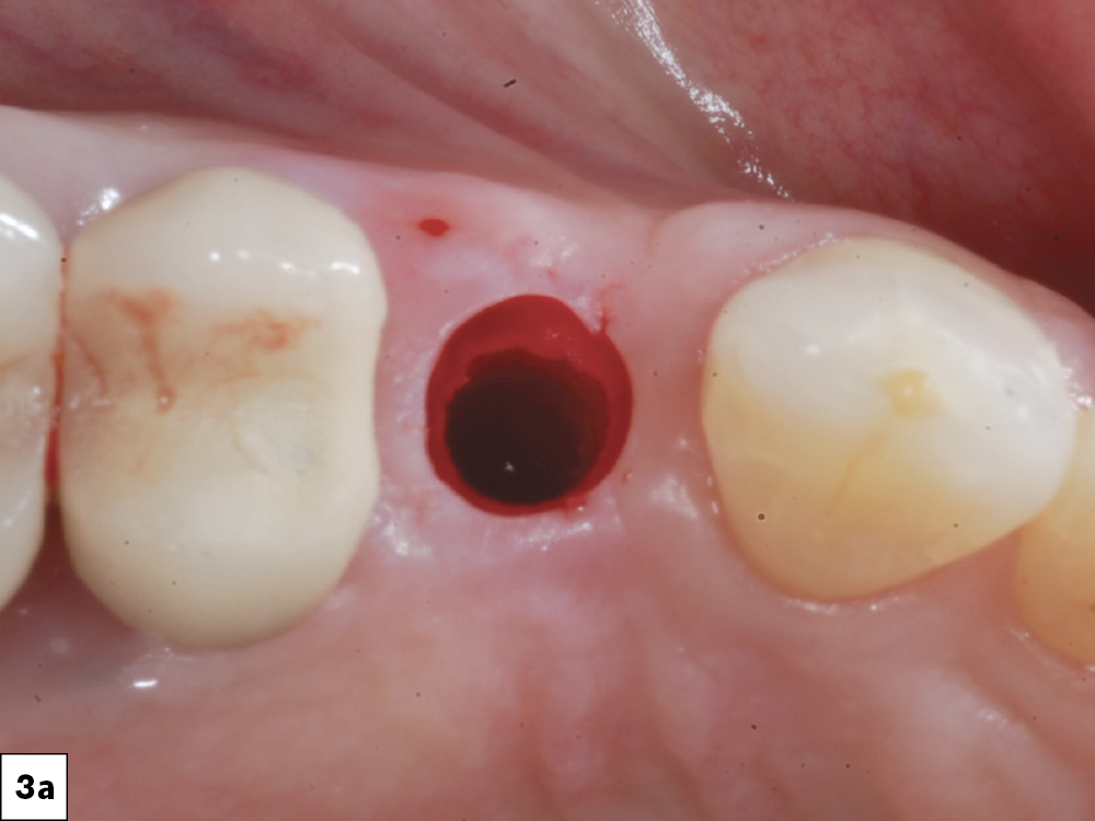 After a flapless surgical procedure, a Hahn Tapered Implant was placed.