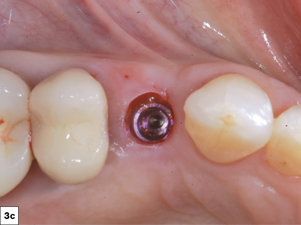 A Hahn Tapered Implant was placed