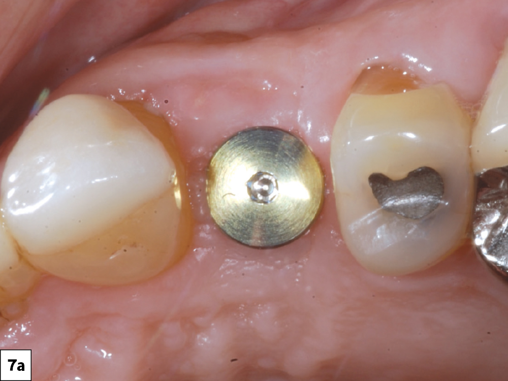 A healing abutment was placed at the implant site
