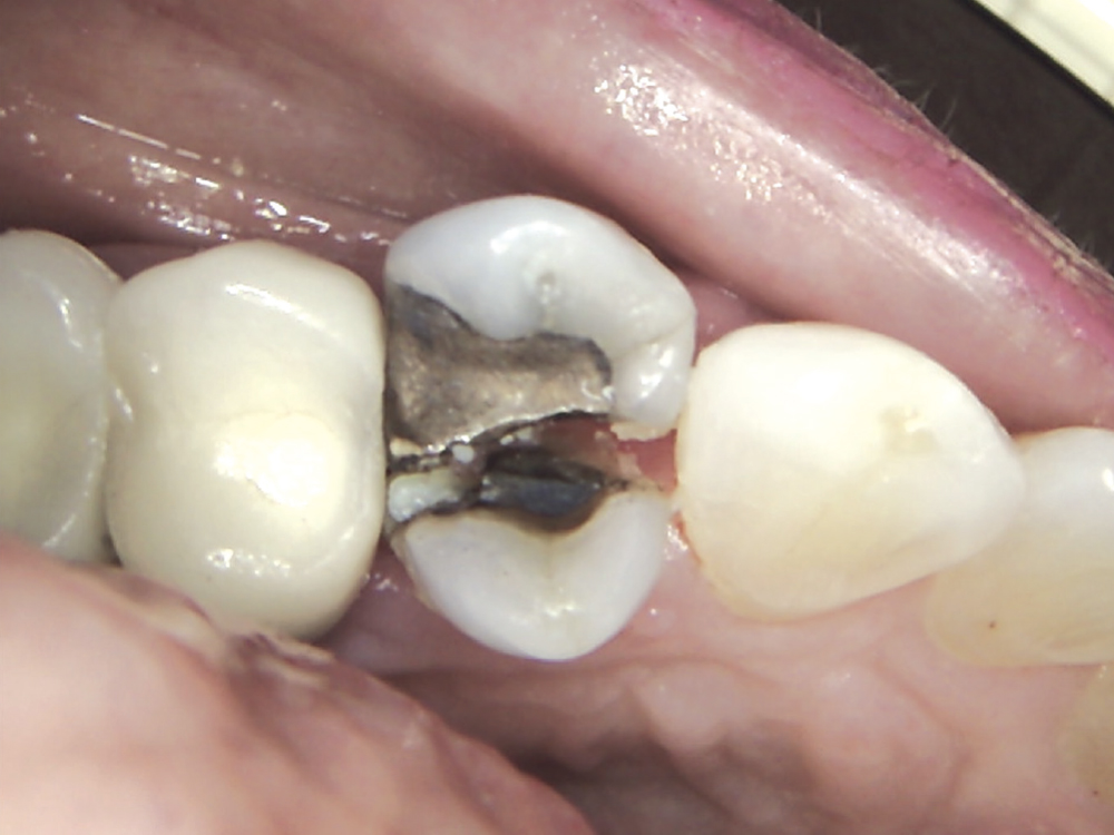 The preoperative appointment: The upper bicuspid was fractured and non-restorable.