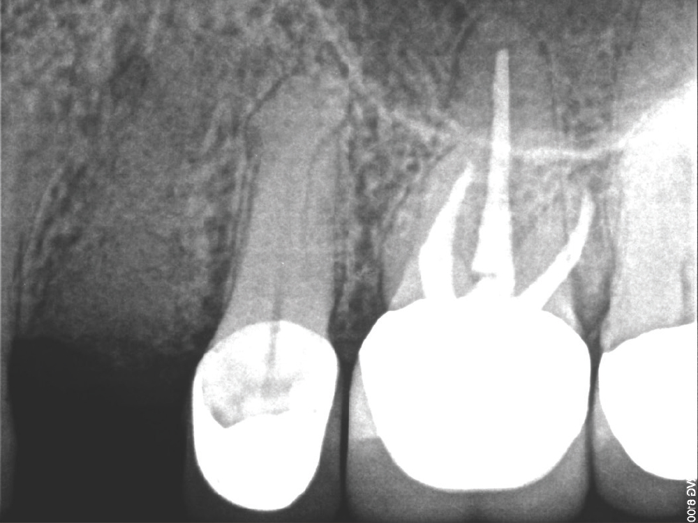 The X-ray taken after extraction and socket grafting showed bone regeneration after four months of healing.