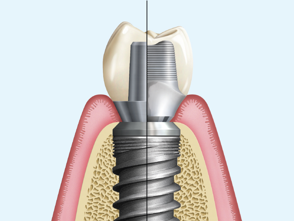 On the left, the deeply subgingival margin is associated with a stock abutment. On the right, an equigingival margin is created with a custom abutment.