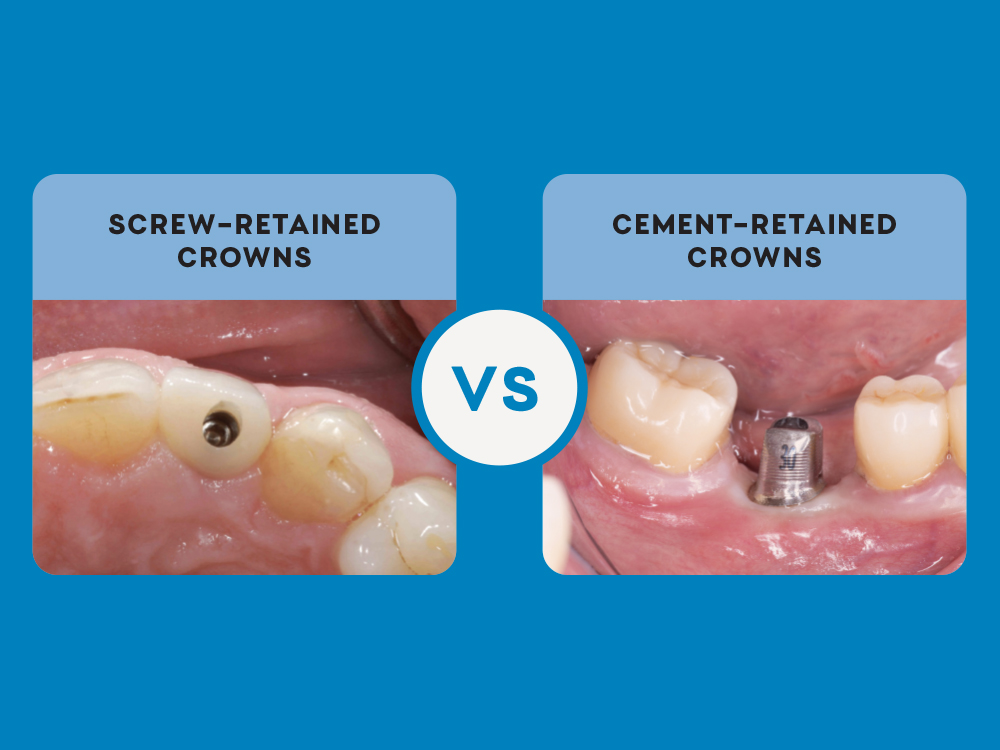 Implant Restorations:  Screw-Retained vs. Cemented