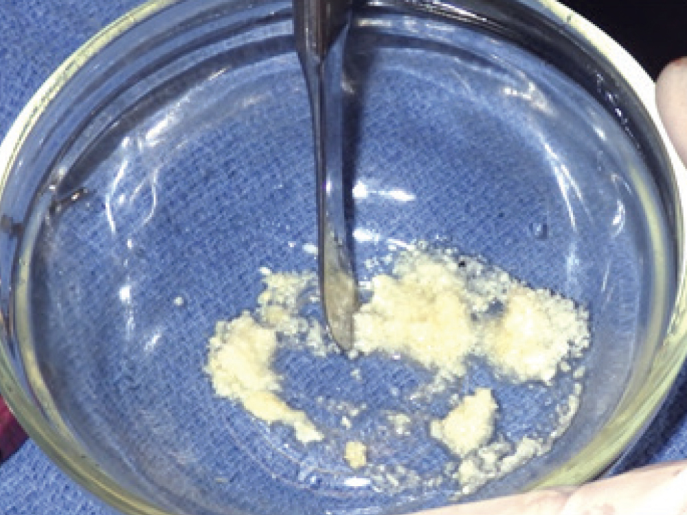 Prophylactic Antibiotic Use in Implant Dentistry (1 CEU)