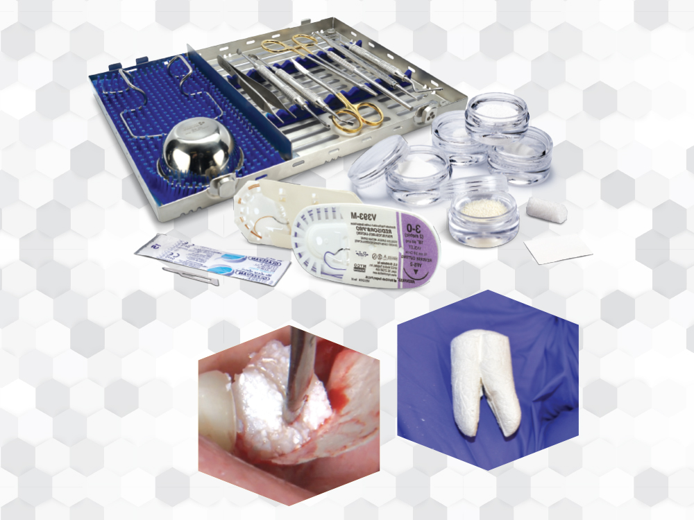 Newport Surgical materials for bone grafting