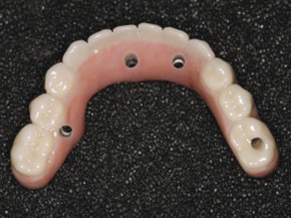 BruxZir® Implant Prosthesis