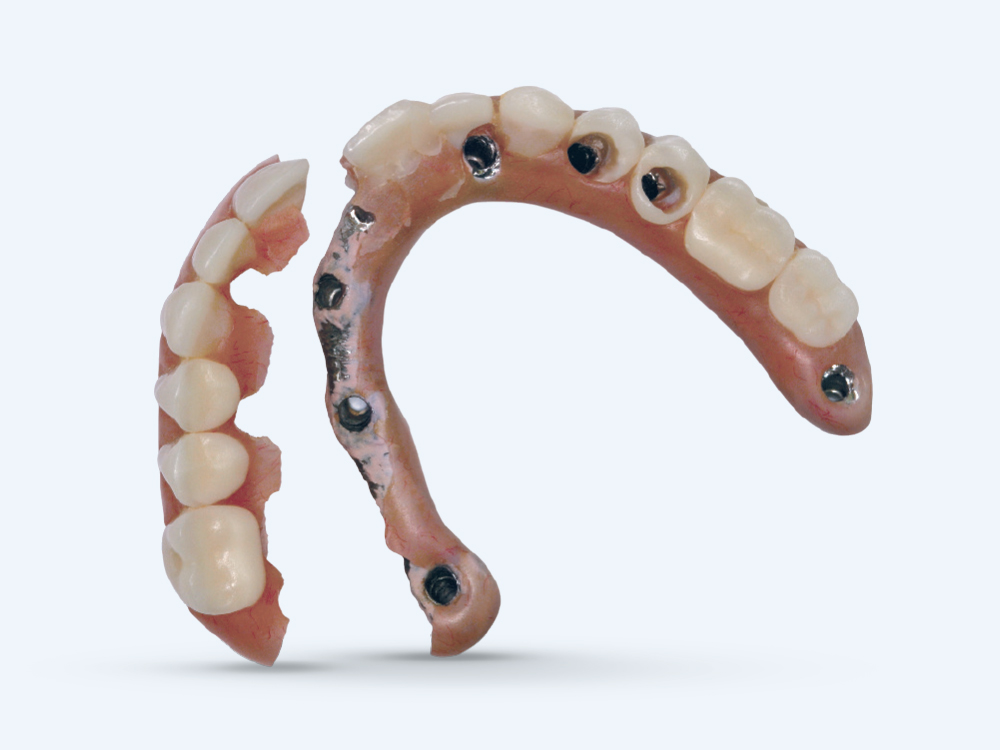 Hybrid dentures