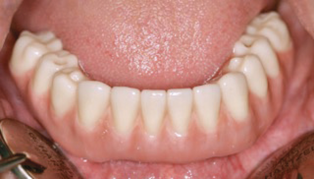 Patient's bottom teeth after BruxZir Implant Prosthesis milled