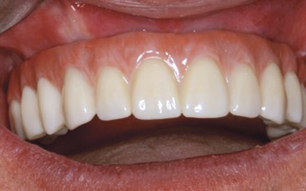 Patient's top teeth after BruxZir Implant Prosthesis milled