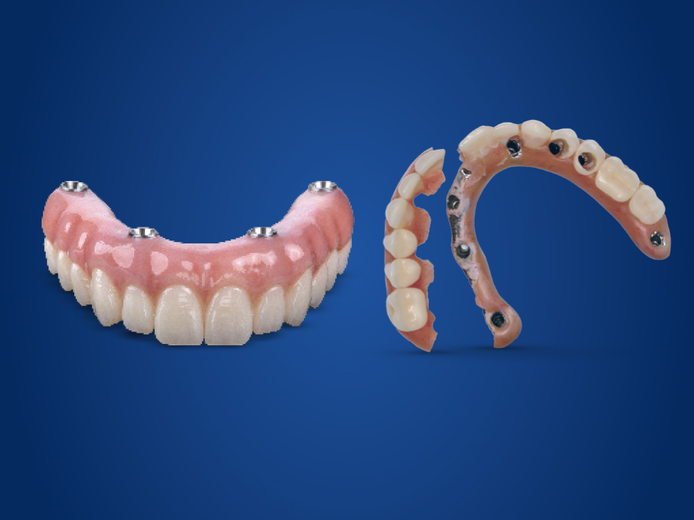 The BruxZir® Implant Prosthesis vs. Acrylic Hybrids