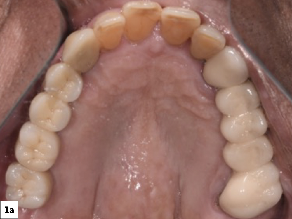 Figure 1a: 76-year old male patient's teeth #11-15