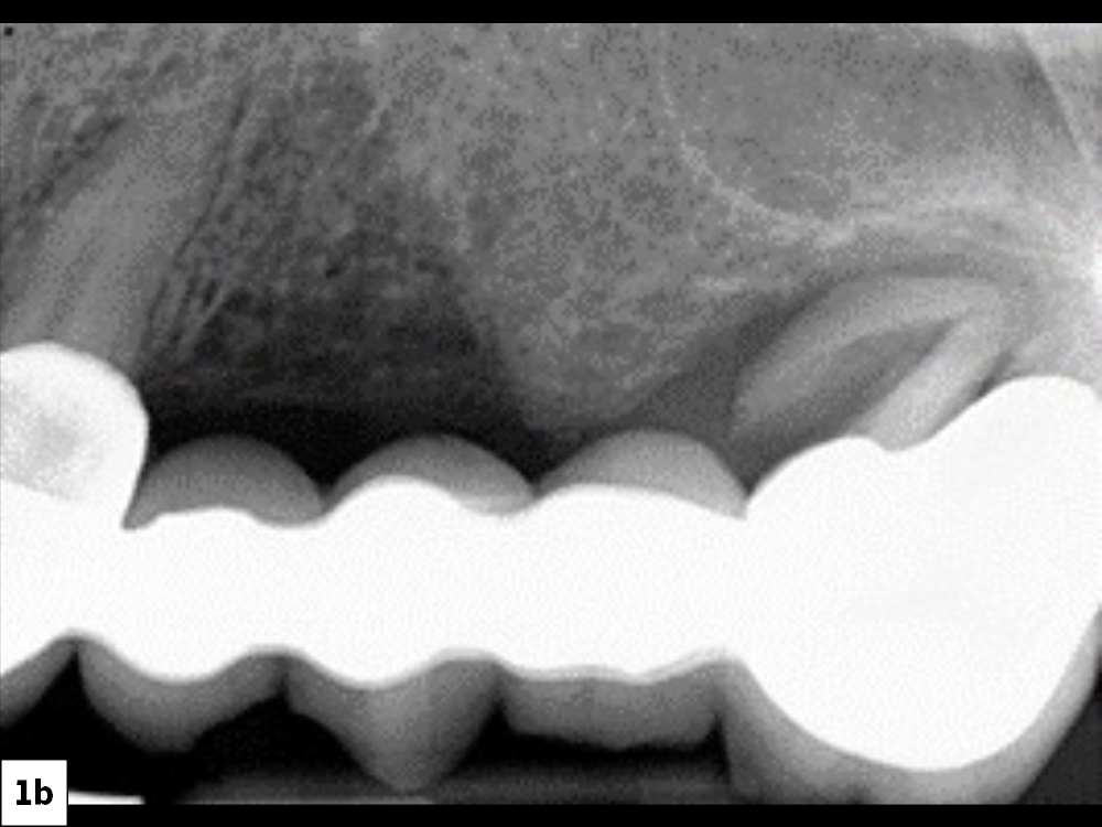 Figure 1b: 76-year old male patient's teeth #11-15
