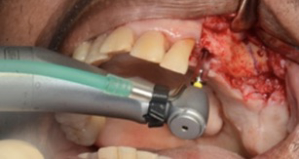 Figure 5: serial osteotomy was prepared for a 3.5 x 11.5 Hahn™ Tapered Implant