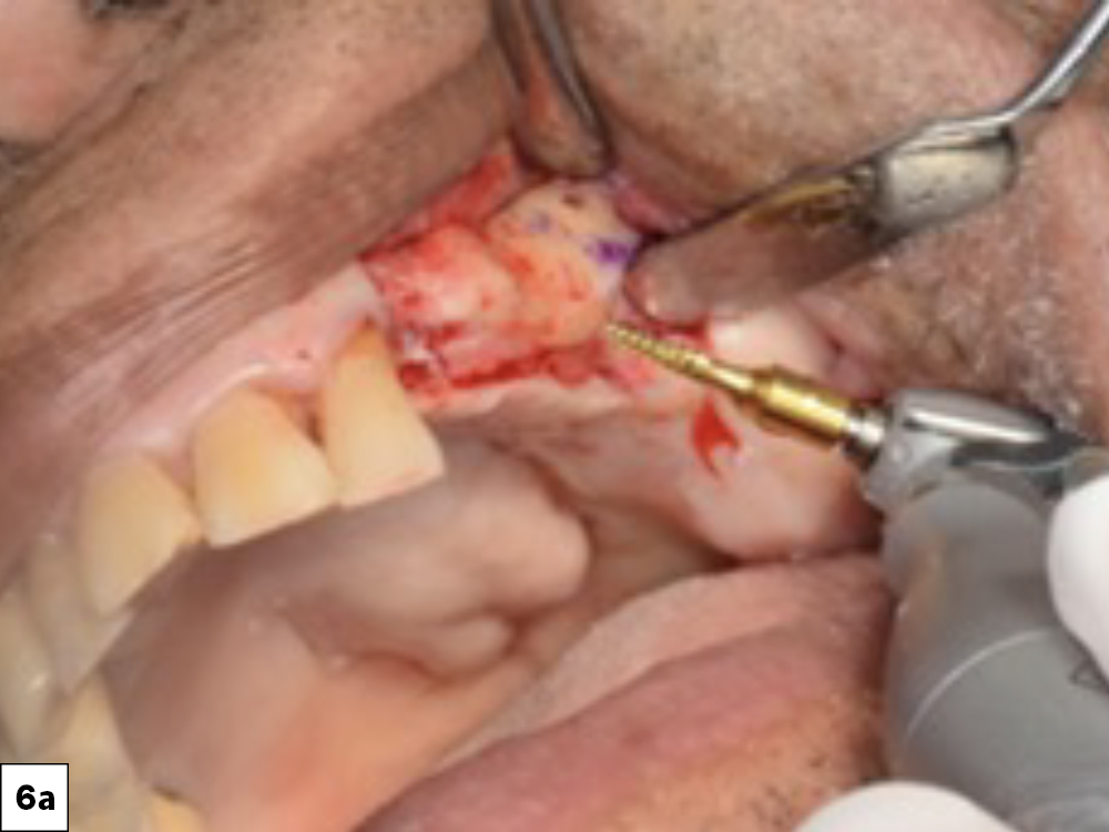 Figure 6a: area of tooth #14