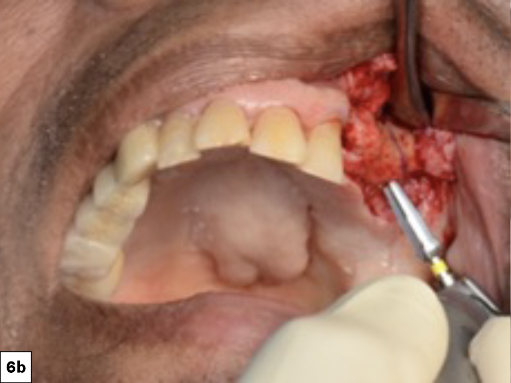 Figure 6b: area of tooth #14