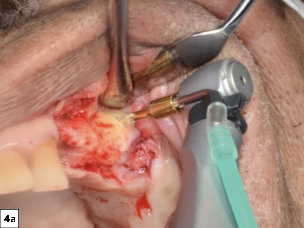 Figure 4a: 2-mm round bur was used to create a pinpoint hole at the lateral wall