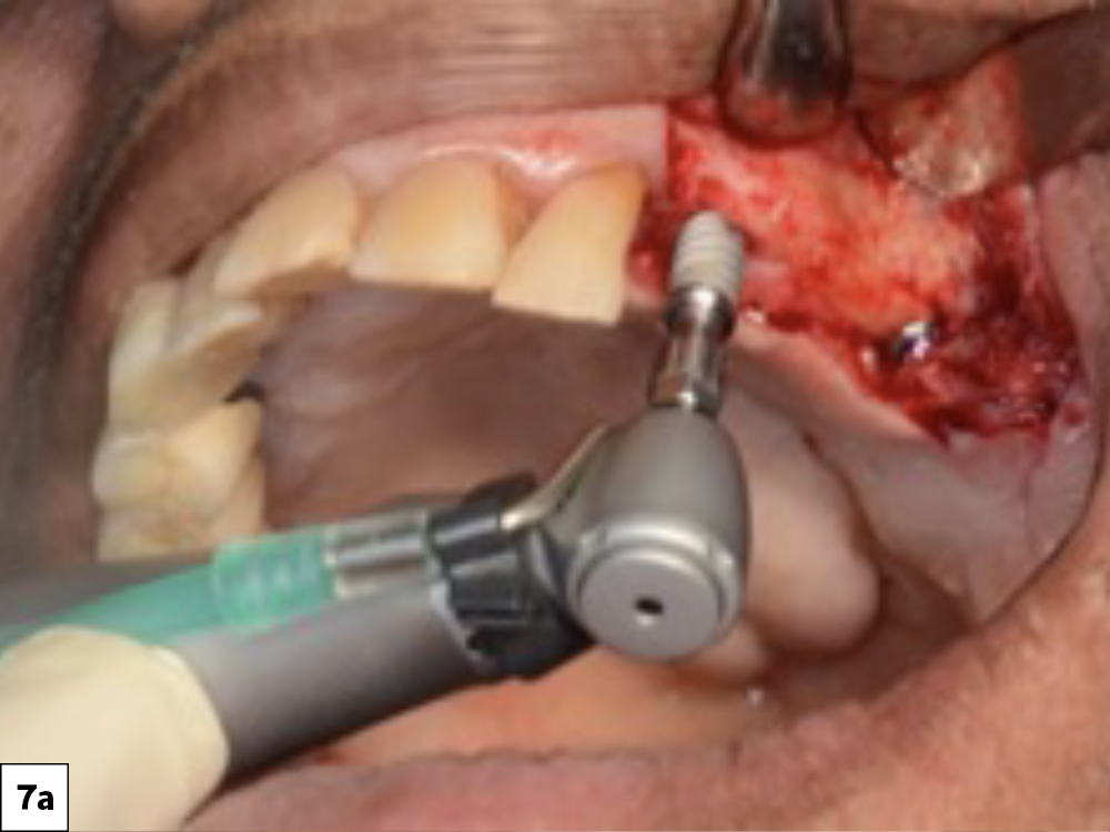 Figure 7a: A 3.5 x 11.5 mm Hahn implant was placed at the site of tooth #11 with 50 Ncm torque