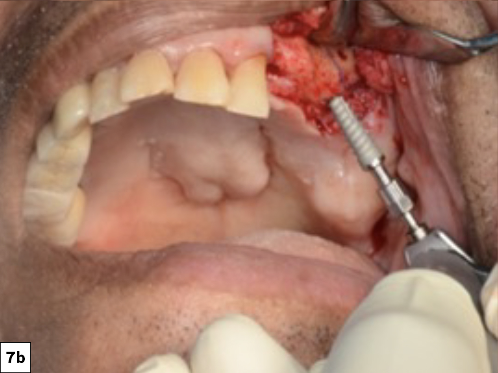 Figure 7b: A 4.3 x 13 mm Hahn implant was inserted at the site of tooth #14 with 60 Ncm torque