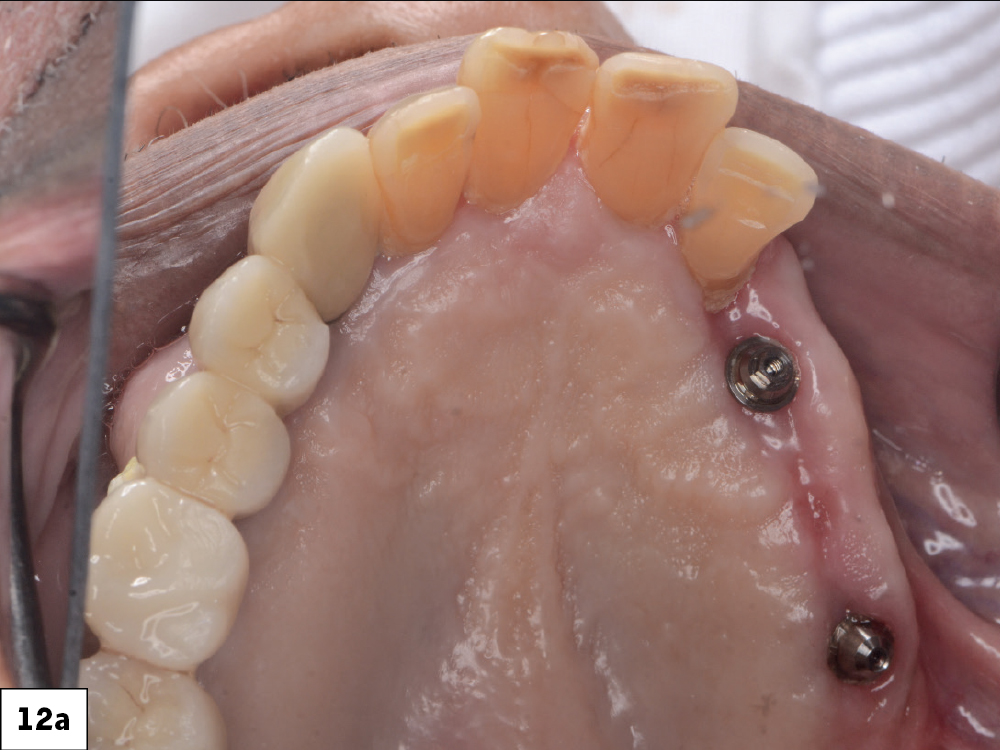 Figure 12a: patient's teeth after one week implant placement