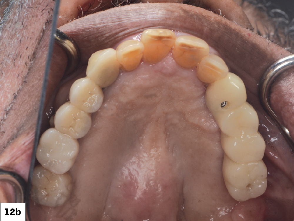 Figure 12b: BioTemps® Provisionals