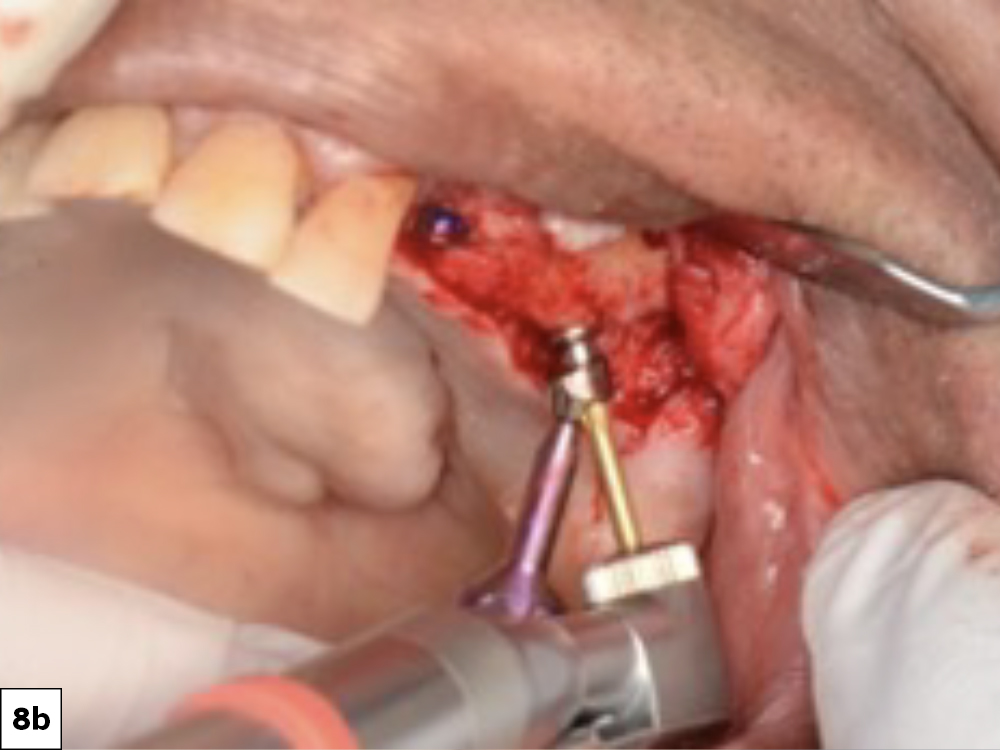 Figure 8b: MUAs were placed on the implant fixtures