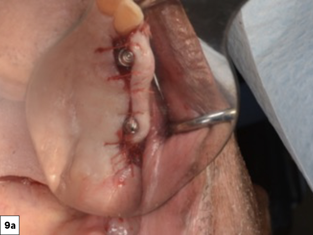 Figure 9a: sutures placed