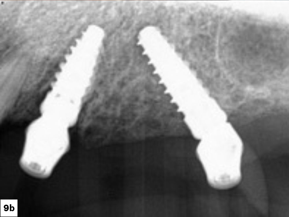 Figure 9b: radiograph taken to confirm position and placement of implants