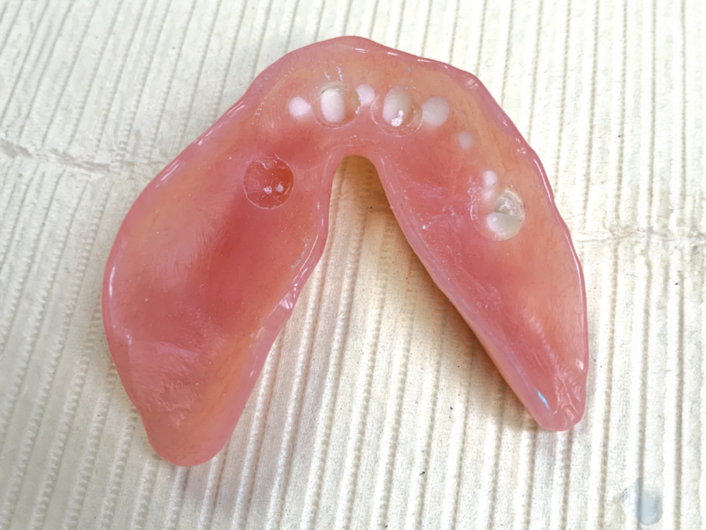 Using a Locator Chairside™ Recess Bur (Zest IP Holdings, LLC), access openings were prepared into the intaglio surface of the denture to provide sufficient room for seating the appliance over the abutments and attachments.